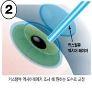 `빛번짐.눈부심' 부작용 해결 `아이라식' 선보여 - 4