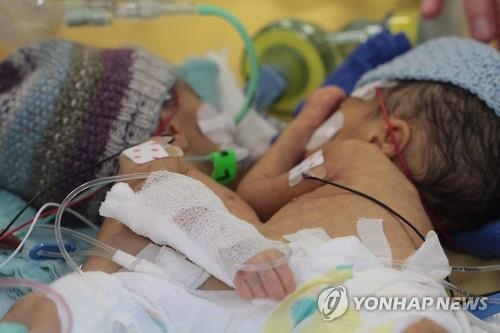 스위스서 생후 8일 샴쌍둥이 분리수술 성공…최연소 기록 - 2