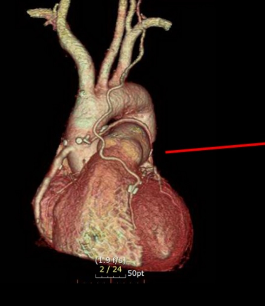 붉은 선으로 가르킨 부분이 내흉동맥을 이어주는 관상동맥우회술 후의 CT 사진이다. 내흉동맥은 수술후 10년 안에 문제가 될 확률이 2%밖에 안 될 정도로 개통률이 매우 우수하다. [서울성모병원 제공]