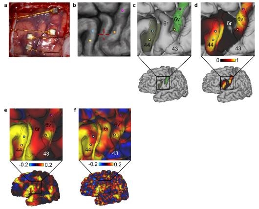루게릭병 환자 뇌에 삽입된 전극과 그 부위의 fMRI 사진