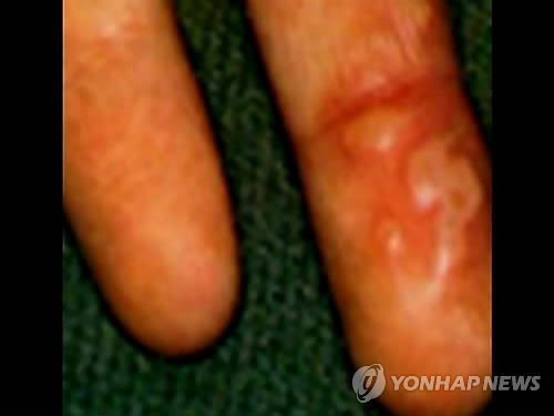 수족구병