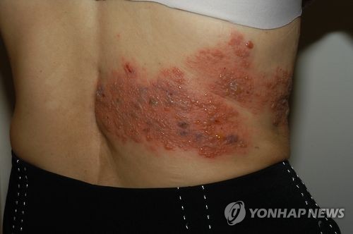 대상포진 [연합뉴스 자료사진[