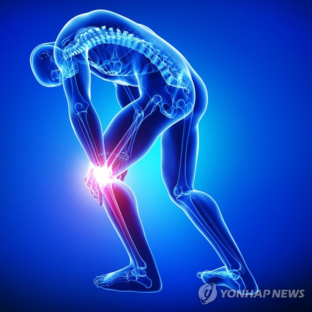 류마티스 관절염
