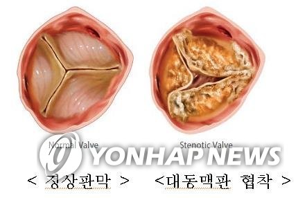 정상 판막과 대동맥판 협착