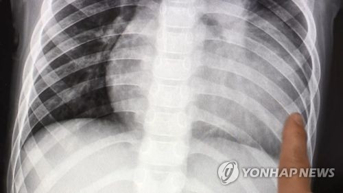 폐 엑스레이