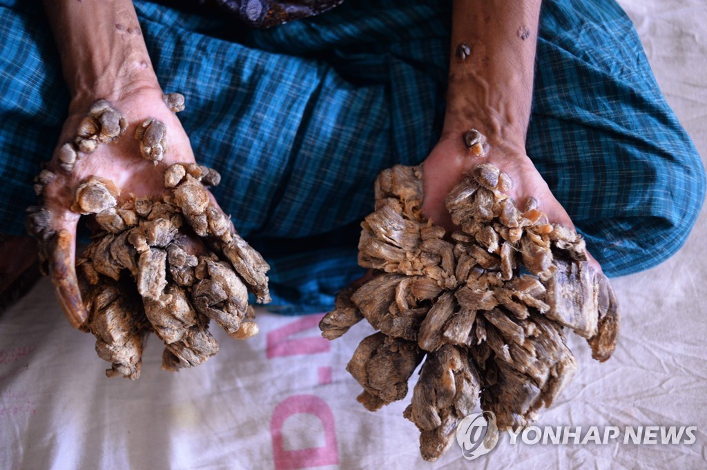 BANGLADESH-HEALTH-TREEMAN