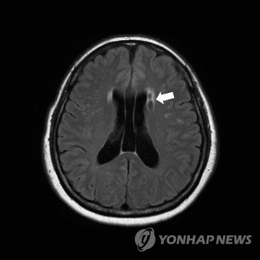 뇌 MRI 사진 (연합뉴스)