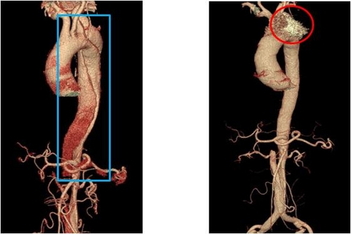 대동맥파열동맥경화박리증 5