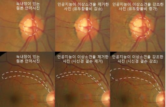 원본 안저사진(왼쪽)과 적대적 설명 방법론으로 생성된 안저사진(가운데, 오른쪽)