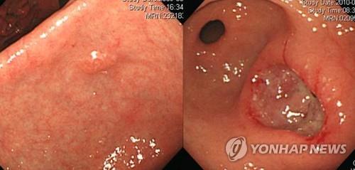 조기 위암(왼쪽)과 진행성 위암(오른쪽)