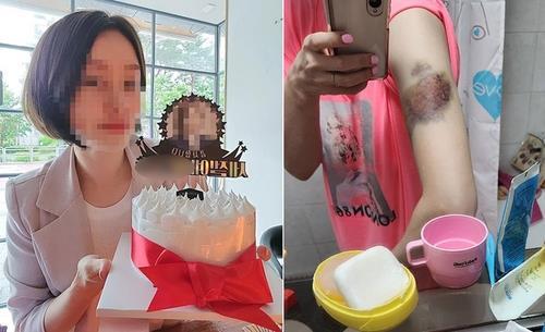 피해자의 생전 모습(왼쪽)과 폭행 피해로 멍이 든 모습.
