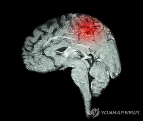 뇌졸중
