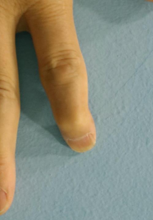 Fingers of a patient with ‘psoriatic arthritis’ [연합뉴스 자료사진]