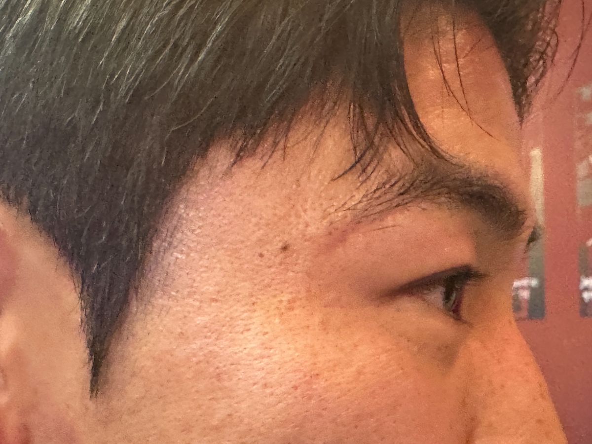 김태현 오른쪽 눈두덩의 흉터