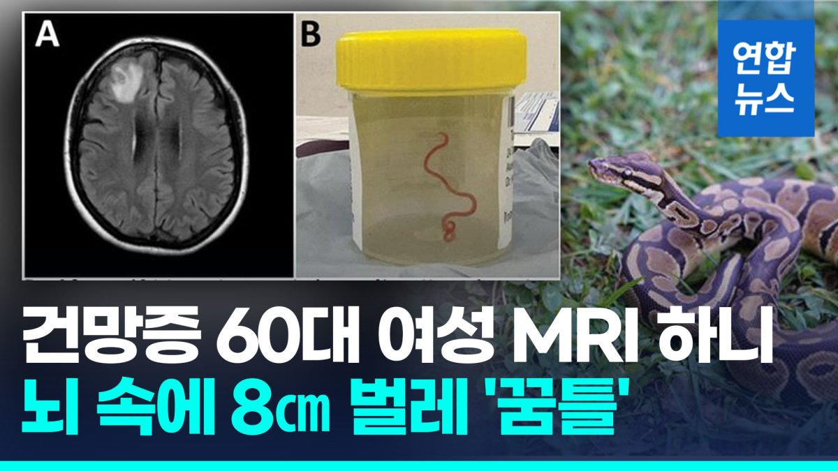 [영상] 호주서 건망증 앓던 여성 뇌 속에 8㎝ 벌레 '꿈틀'