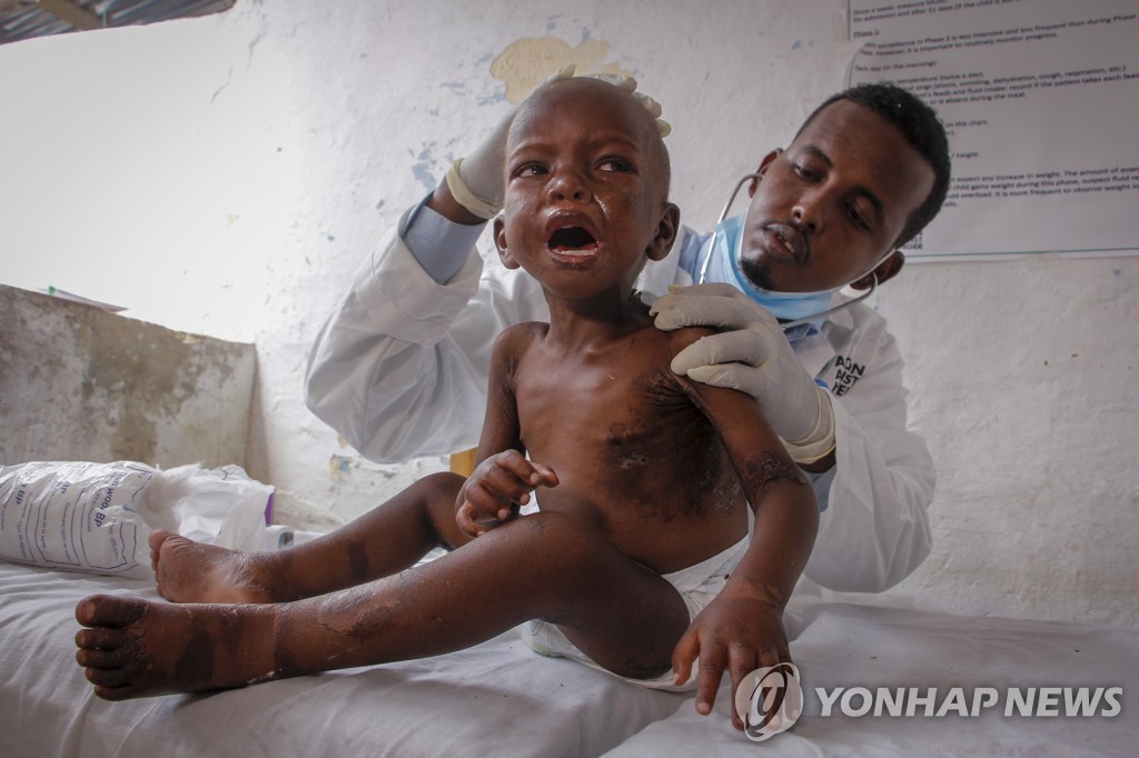 영양실조로 치료받는 소말리아 아동 
